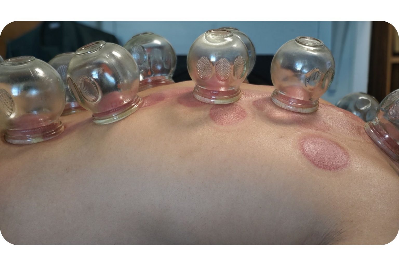 Living-Chi-Fire-Cupping